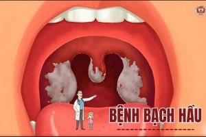 Bệnh bạch hầu là gì? Phương pháp điều trị an toàn, hiệu quả